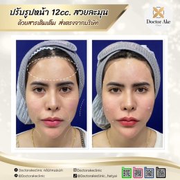 Filler ปรับรูปหน้า