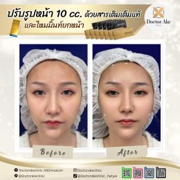 Filler ปรับรูปหน้า