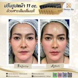 Filler ปรับรูปหน้า