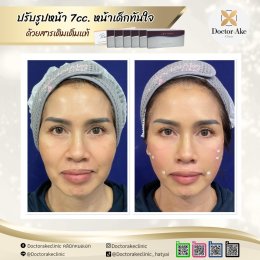 Filler ปรับรูปหน้า