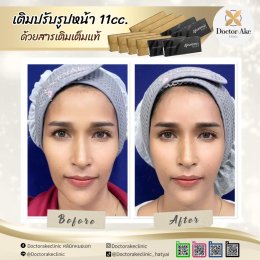 Filler หน้าผาก