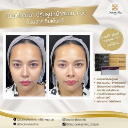 Filler ปรับรูปหน้า