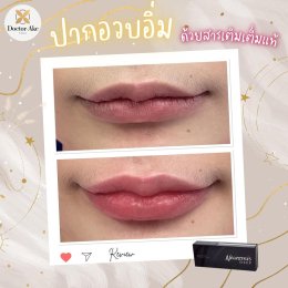 Filler ปาก