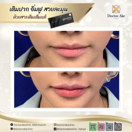 Filler ปาก