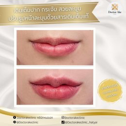 Filler ปาก