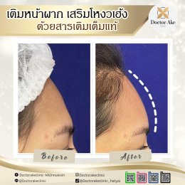 Filler หน้าผาก