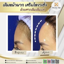 Filler หน้าผาก