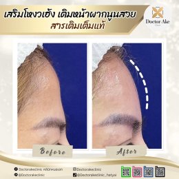 Filler หน้าผาก