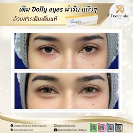 Filler ดอลลี่อาย