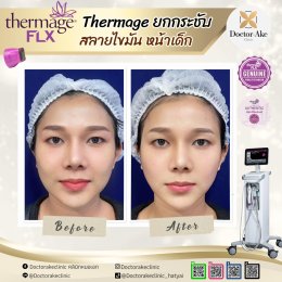 Thermage FLX