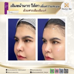 Filler หน้าผาก