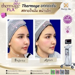 Thermage FLX