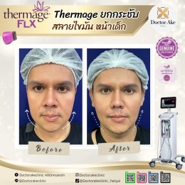 Thermage FLX