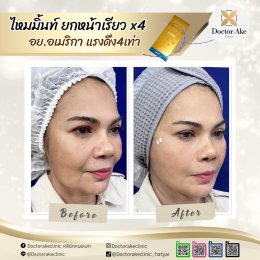 ร้อยไหม Premium Mint Lift