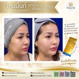 ร้อยไหม Premium Mint Lift