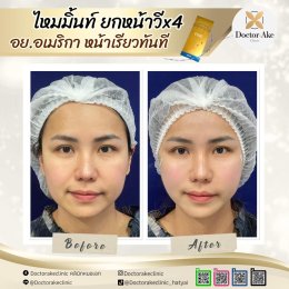 ร้อยไหม Premium Mint Lift