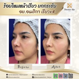 ร้อยไหม Premium Mint Lift