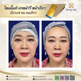 ร้อยไหม Premium Mint Lift