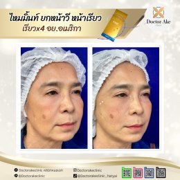 ร้อยไหม Premium Mint Lift