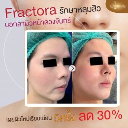 Fractora หลุมสิว