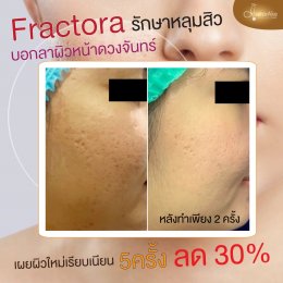 Fractora หลุมสิว