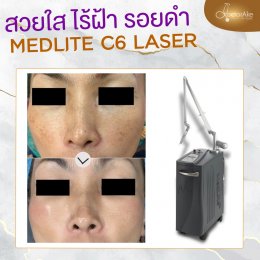 Medlite ฝ้า กระ รอยดำ