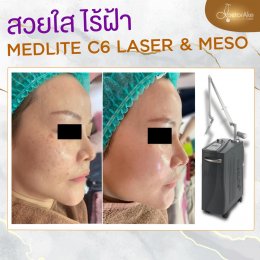 Medlite ฝ้า กระ รอยดำ