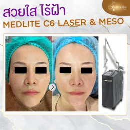 Medlite ฝ้า กระ รอยดำ