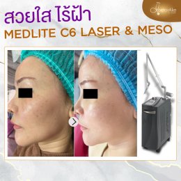 Medlite ฝ้า กระ รอยดำ