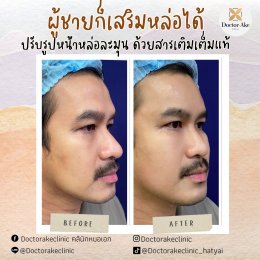 Filler ปรับรูปหน้า