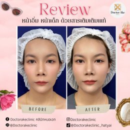 Filler ปรับรูปหน้า ฟิลเลอร์ปรับรูปหน้า หาดใหญ่