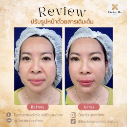 Filler ปรับรูปหน้า ฟิลเลอร์ปรับรูปหน้า หาดใหญ่