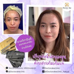 Filler ปรับรูปหน้า