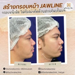 Filler ปรับรูปหน้า