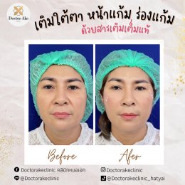 Filler ปรับรูปหน้า