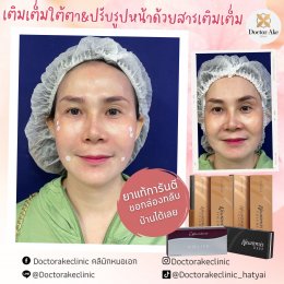 Filler ปรับรูปหน้า