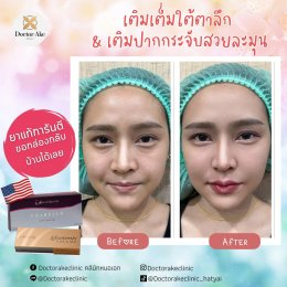 Filler ปรับรูปหน้า