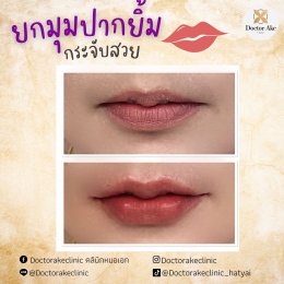 Filler ปาก