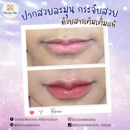 Filler ปาก