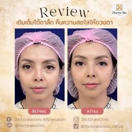 Filler ใต้ตา ฟิลเลอร์ใต้ตา