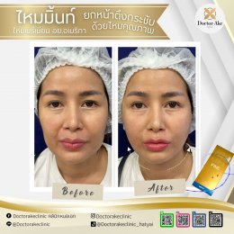 ร้อยไหม Premium Mint Lift