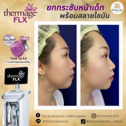 Thermage FLX