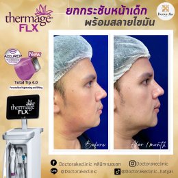 Thermage FLX