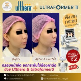 โปรแกรมยกกระชับด้วย Ultherapy SPT