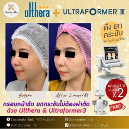 โปรแกรมยกกระชับด้วย Ultherapy SPT