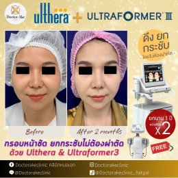 โปรแกรมยกกระชับด้วย Ultherapy SPT