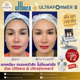 โปรแกรมยกกระชับด้วย Ultherapy SPT