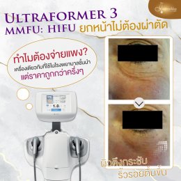 Ultraformer III