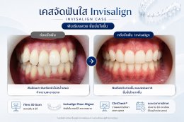 เคสจัดฟันใส Invisalign ก่อนและหลัง | Dental Art Elite