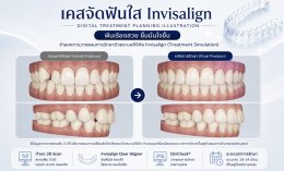 เคสจัดฟันใส Invisalign ก่อนและหลัง | Dental Art Elite